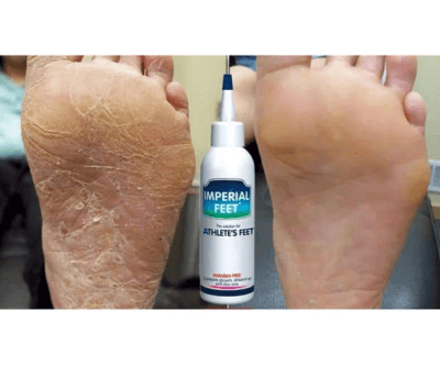 ATHLETE’S FOOT 75ml - Image 2