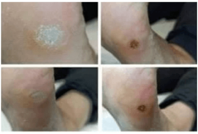WARTS 20ml - Image 4