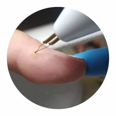 Cautery pen-Ανταλλακτική πέννα - Image 2